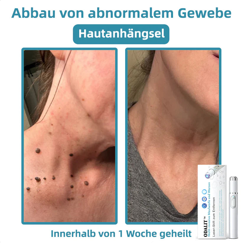 [𝗦𝗶𝗰𝗵𝘁𝗯𝗮𝗿𝗲 𝗘𝗿𝗴𝗲𝗯𝗻𝗶𝘀𝘀𝗲 𝗶𝗻 𝗻𝘂𝗿 𝟳 𝗧𝗮𝗴𝗲𝗻]👨‍⚕️ODALIT™ N𝐢ch𝐭-i𝐧va𝐬iv 𝐋𝐞b𝐞rfl𝐞ck- 𝐮𝐧𝐝 𝐖𝐚rz𝐞n𝐞n𝐭f𝐞r𝐧𝐮𝐧g𝐬-La𝐬𝐞r𝐬tift 𝐏𝐫o𝐦ox(𝗦𝗰𝗵𝗻𝗲𝗹𝗹𝗲 𝘂𝗻𝗱 𝘀𝗰𝗵𝗺𝗲𝗿𝘇𝗳𝗿𝗲𝗶𝗲 𝗘𝗻𝘁𝗳𝗲𝗿𝗻𝘂𝗻𝗴 𝘃𝗼𝗻 𝗪𝗮𝗿𝘇𝗲𝗻, 𝗠𝘂𝘁𝘁𝗲𝗿𝗺𝗮𝗹𝗲𝗻, 𝗔𝗹𝘁𝗲𝗿𝘀𝗳𝗹𝗲𝗰𝗸𝗲𝗻 𝘂𝗻𝗱 𝗛𝗮𝘂𝘁𝗮𝗻𝗵ä𝗻𝗴𝘀𝗲𝗹𝗻 – 𝗴𝗮𝗻𝘇 𝗼𝗵𝗻𝗲 𝗡𝗲𝗯𝗲𝗻𝘄𝗶𝗿𝗸𝘂𝗻𝗴𝗲𝗻)🫐