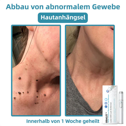 [𝗦𝗶𝗰𝗵𝘁𝗯𝗮𝗿𝗲 𝗘𝗿𝗴𝗲𝗯𝗻𝗶𝘀𝘀𝗲 𝗶𝗻 𝗻𝘂𝗿 𝟳 𝗧𝗮𝗴𝗲𝗻]👨‍⚕️ODALIT™ N𝐢ch𝐭-i𝐧va𝐬iv 𝐋𝐞b𝐞rfl𝐞ck- 𝐮𝐧𝐝 𝐖𝐚rz𝐞n𝐞n𝐭f𝐞r𝐧𝐮𝐧g𝐬-La𝐬𝐞r𝐬tift 𝐏𝐫o𝐦ox(𝗦𝗰𝗵𝗻𝗲𝗹𝗹𝗲 𝘂𝗻𝗱 𝘀𝗰𝗵𝗺𝗲𝗿𝘇𝗳𝗿𝗲𝗶𝗲 𝗘𝗻𝘁𝗳𝗲𝗿𝗻𝘂𝗻𝗴 𝘃𝗼𝗻 𝗪𝗮𝗿𝘇𝗲𝗻, 𝗠𝘂𝘁𝘁𝗲𝗿𝗺𝗮𝗹𝗲𝗻, 𝗔𝗹𝘁𝗲𝗿𝘀𝗳𝗹𝗲𝗰𝗸𝗲𝗻 𝘂𝗻𝗱 𝗛𝗮𝘂𝘁𝗮𝗻𝗵ä𝗻𝗴𝘀𝗲𝗹𝗻 – 𝗴𝗮𝗻𝘇 𝗼𝗵𝗻𝗲 𝗡𝗲𝗯𝗲𝗻𝘄𝗶𝗿𝗸𝘂𝗻𝗴𝗲𝗻)🫐