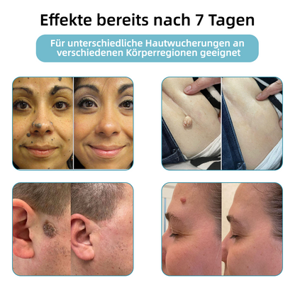 [𝗦𝗶𝗰𝗵𝘁𝗯𝗮𝗿𝗲 𝗘𝗿𝗴𝗲𝗯𝗻𝗶𝘀𝘀𝗲 𝗶𝗻 𝗻𝘂𝗿 𝟳 𝗧𝗮𝗴𝗲𝗻]👨‍⚕️ODALIT™ N𝐢ch𝐭-i𝐧va𝐬iv 𝐋𝐞b𝐞rfl𝐞ck- 𝐮𝐧𝐝 𝐖𝐚rz𝐞n𝐞n𝐭f𝐞r𝐧𝐮𝐧g𝐬-La𝐬𝐞r𝐬tift 𝐏𝐫o𝐦ox(𝗦𝗰𝗵𝗻𝗲𝗹𝗹𝗲 𝘂𝗻𝗱 𝘀𝗰𝗵𝗺𝗲𝗿𝘇𝗳𝗿𝗲𝗶𝗲 𝗘𝗻𝘁𝗳𝗲𝗿𝗻𝘂𝗻𝗴 𝘃𝗼𝗻 𝗪𝗮𝗿𝘇𝗲𝗻, 𝗠𝘂𝘁𝘁𝗲𝗿𝗺𝗮𝗹𝗲𝗻, 𝗔𝗹𝘁𝗲𝗿𝘀𝗳𝗹𝗲𝗰𝗸𝗲𝗻 𝘂𝗻𝗱 𝗛𝗮𝘂𝘁𝗮𝗻𝗵ä𝗻𝗴𝘀𝗲𝗹𝗻 – 𝗴𝗮𝗻𝘇 𝗼𝗵𝗻𝗲 𝗡𝗲𝗯𝗲𝗻𝘄𝗶𝗿𝗸𝘂𝗻𝗴𝗲𝗻)🫐