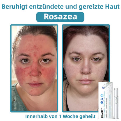 [𝗦𝗶𝗰𝗵𝘁𝗯𝗮𝗿𝗲 𝗘𝗿𝗴𝗲𝗯𝗻𝗶𝘀𝘀𝗲 𝗶𝗻 𝗻𝘂𝗿 𝟳 𝗧𝗮𝗴𝗲𝗻]👨‍⚕️ODALIT™ N𝐢ch𝐭-i𝐧va𝐬iv 𝐋𝐞b𝐞rfl𝐞ck- 𝐮𝐧𝐝 𝐖𝐚rz𝐞n𝐞n𝐭f𝐞r𝐧𝐮𝐧g𝐬-La𝐬𝐞r𝐬tift 𝐏𝐫o𝐦ox(𝗦𝗰𝗵𝗻𝗲𝗹𝗹𝗲 𝘂𝗻𝗱 𝘀𝗰𝗵𝗺𝗲𝗿𝘇𝗳𝗿𝗲𝗶𝗲 𝗘𝗻𝘁𝗳𝗲𝗿𝗻𝘂𝗻𝗴 𝘃𝗼𝗻 𝗪𝗮𝗿𝘇𝗲𝗻, 𝗠𝘂𝘁𝘁𝗲𝗿𝗺𝗮𝗹𝗲𝗻, 𝗔𝗹𝘁𝗲𝗿𝘀𝗳𝗹𝗲𝗰𝗸𝗲𝗻 𝘂𝗻𝗱 𝗛𝗮𝘂𝘁𝗮𝗻𝗵ä𝗻𝗴𝘀𝗲𝗹𝗻 – 𝗴𝗮𝗻𝘇 𝗼𝗵𝗻𝗲 𝗡𝗲𝗯𝗲𝗻𝘄𝗶𝗿𝗸𝘂𝗻𝗴𝗲𝗻)🫐